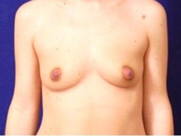 Breast Augmentation