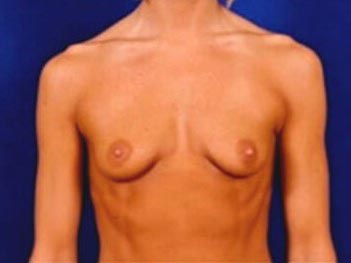 Breast Augmentation