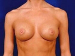 Breast Augmentation