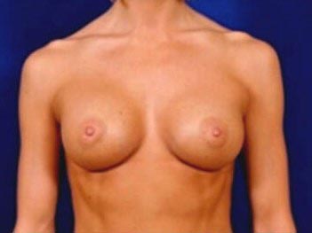 Breast Augmentation