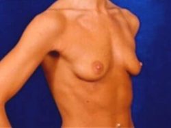 Breast Augmentation