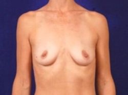 Breast Augmentation