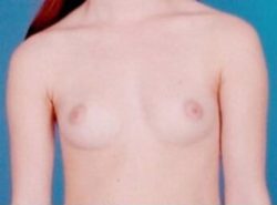 Breast Augmentation