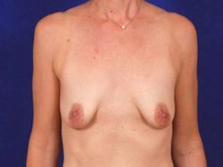 Breast Augmentation