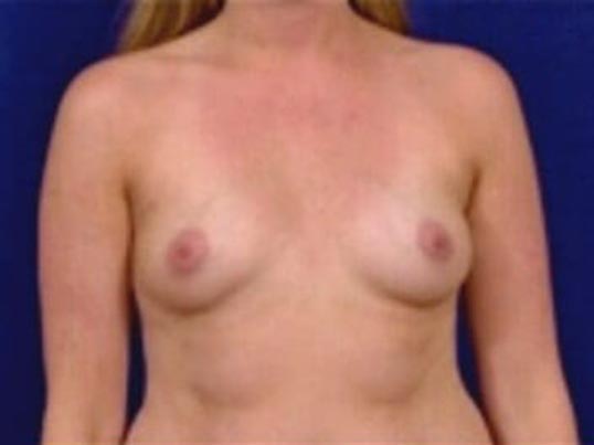 Breast Augmentation