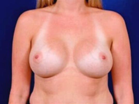 Breast Augmentation