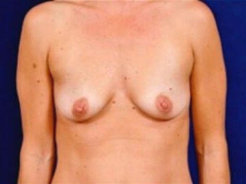 Breast Augmentation