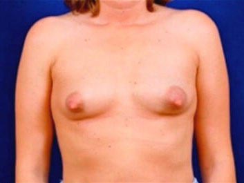 Breast Augmentation