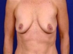 Breast Augmentation