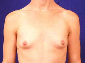 Breast Augmentation