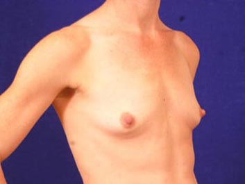 Breast Augmentation