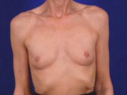 Breast Augmentation