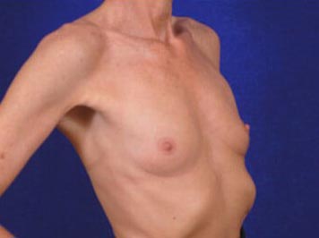 Breast Augmentation