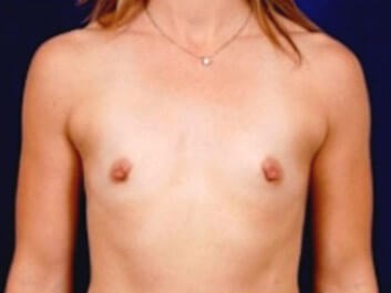 Breast Augmentation