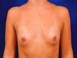 Breast Augmentation