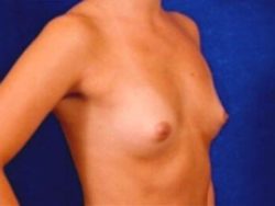 Breast Augmentation