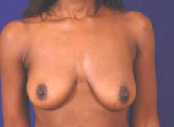 Breast Augmentation