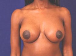 Breast Augmentation