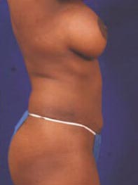 Breast Augmentation