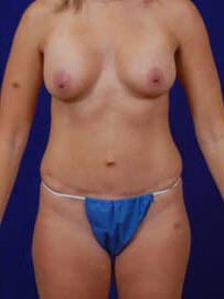 Breast Augmentation