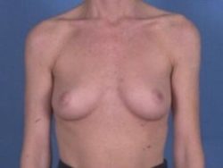 Breast Augmentation