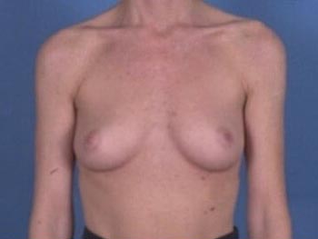 Breast Augmentation