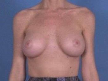 Breast Augmentation