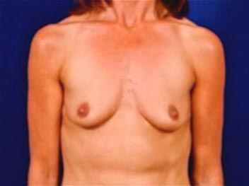 Breast Augmentation