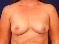 Breast Augmentation