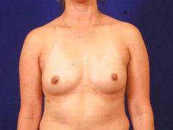 Breast Augmentation