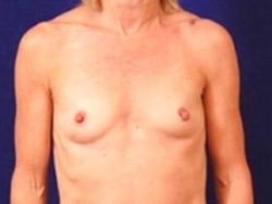 Breast Augmentation