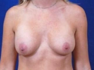 Breast Augmentation