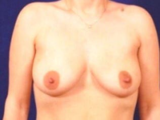 Breast Augmentation