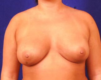 Breast Augmentation