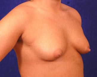 Breast Augmentation