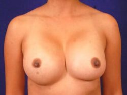 Breast Augmentation