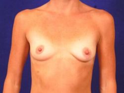 Breast Augmentation