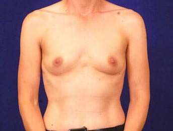 Breast Augmentation