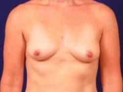 Breast Augmentation