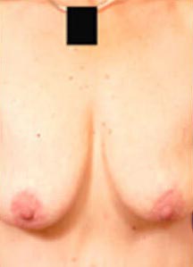 Breast Lift