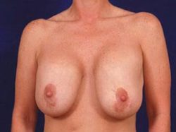 Breast Revision