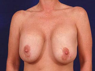 Breast Revision