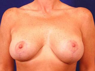 Breast Revision