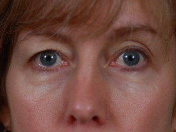 Eyelid Surgery