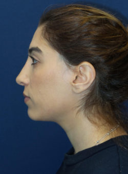 Rhinoplasty