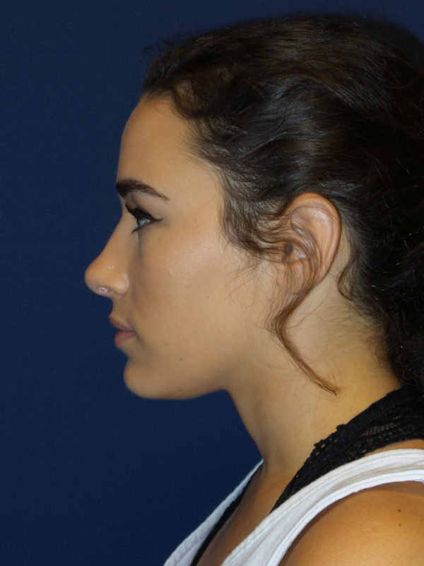 Rhinoplasty