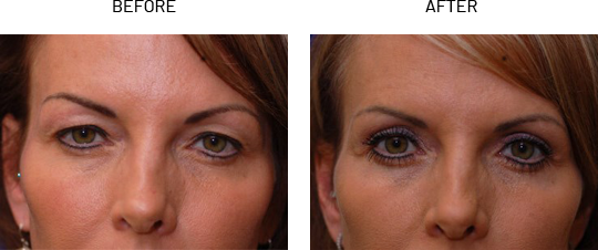 Eyelid Surgery