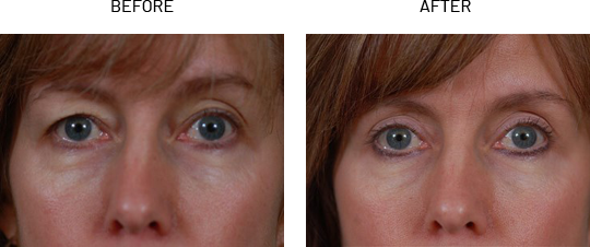 Blepharoplasty