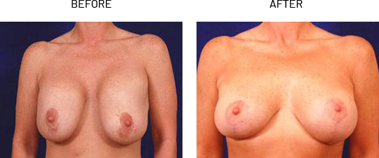 Breast Implant Revision