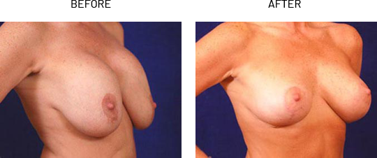 Saline or Silicone Breast Implants Replacement